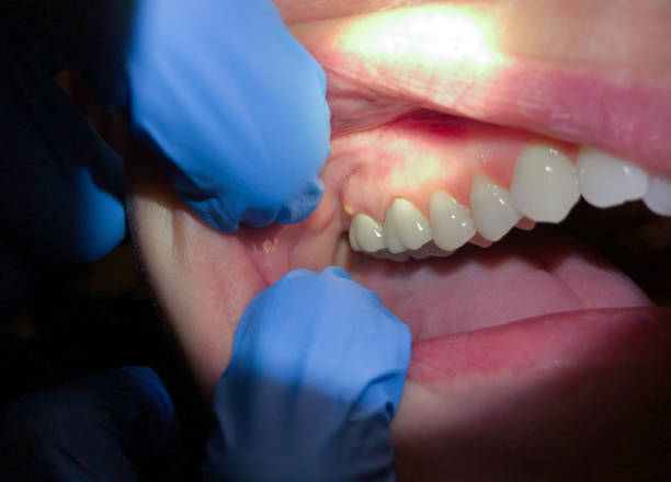 Best Chipped Tooth Repair Near Me  in Lowell, IN